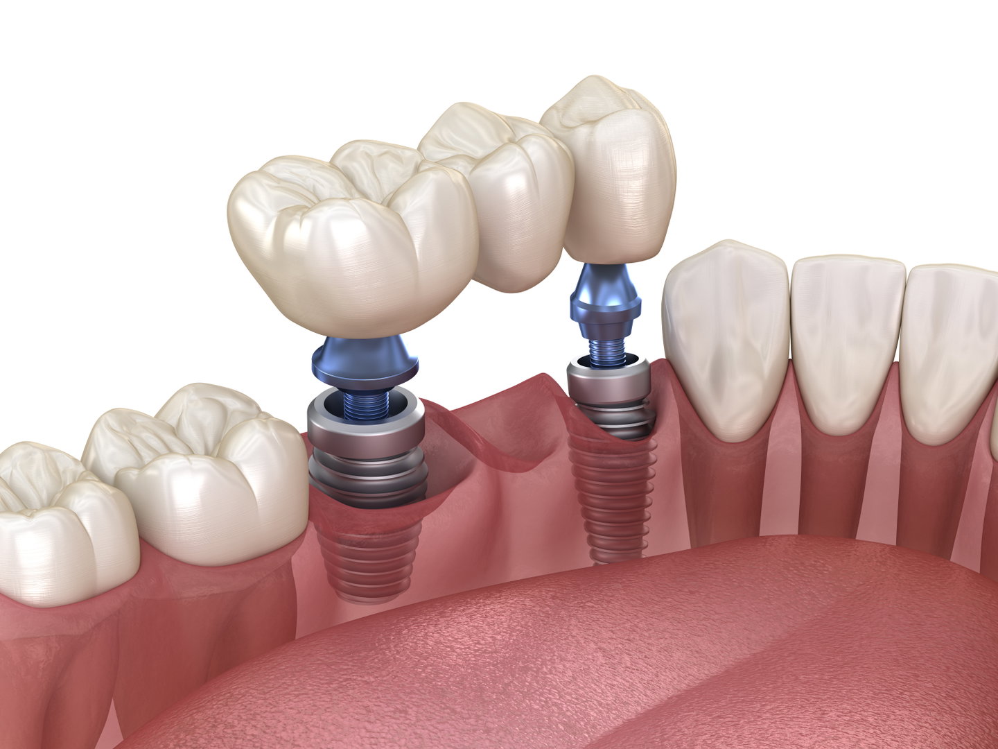 implant-dentist3
