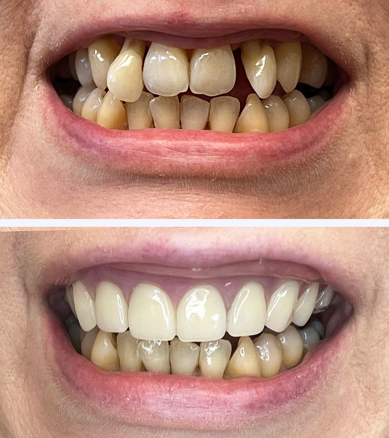 Dental Implants in 