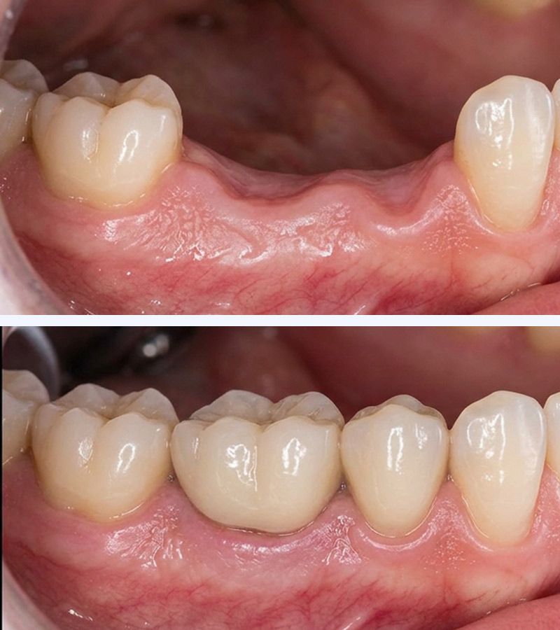Dental Implants in 