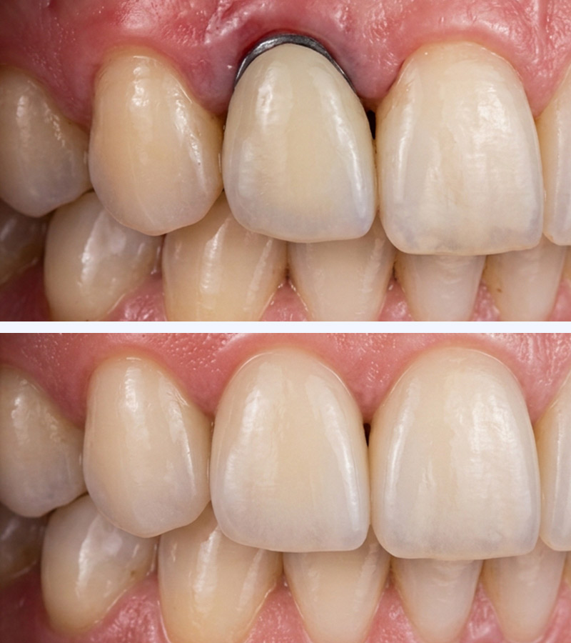 Dental Implants in 