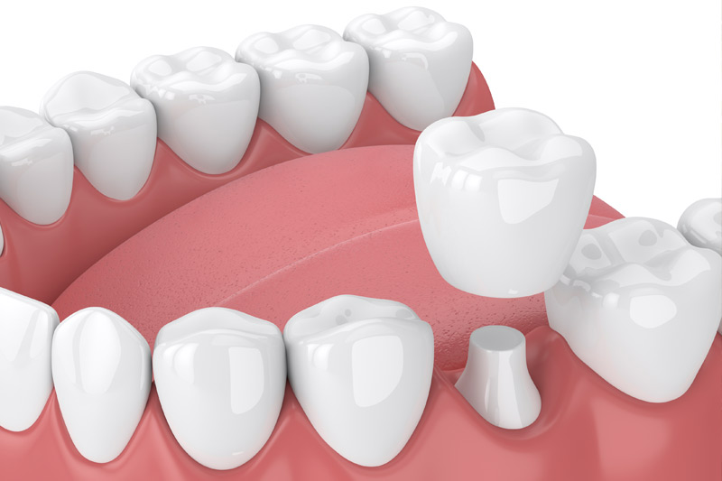 Dental Crowns in Snoqualmie