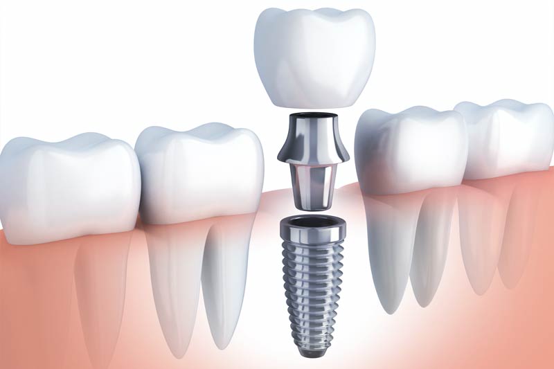 Implants Dentist in Snoqualmie