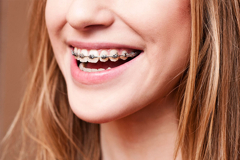 Orthodontics in Snoqualmie